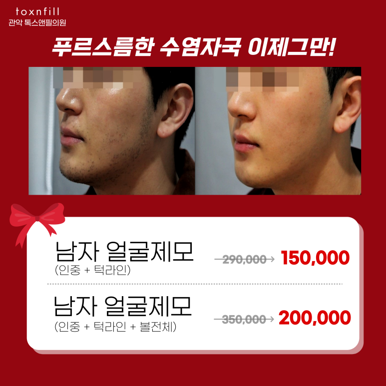 서울대입구역피부과에서 남자수염제모 할인혜택받음 관련 이미지 6