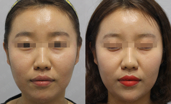 서울대입구역 피부과 과하지않게 애교필러해야하는이유? 관련 이미지 3