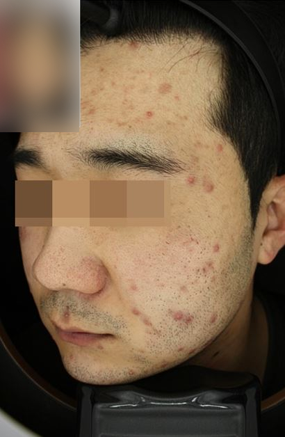 서울대입구역 피부과 여드름치료 고민이라면 관련 이미지 2