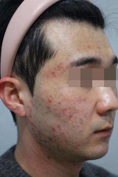 관악구피부과에서 여드름치료로 효과 본 후기! 관련 이미지 2