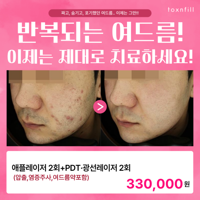 Treatment That Knows the Cause of Acne, Speaks Through Results. image 1
