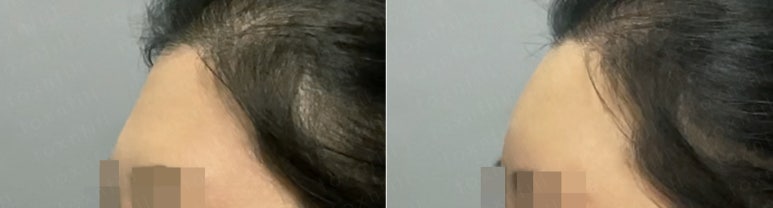 서울대입구역 피부과에서 이마필러로 볼륨감 채웠어!!#자연스럽다 관련 이미지 3