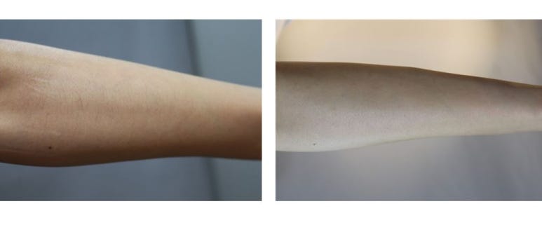 [톡스앤필관악점] 여름철 제모 어디서? 팔제모 톡스앤필에서!! 팔제모 후기!! 관련 이미지 1