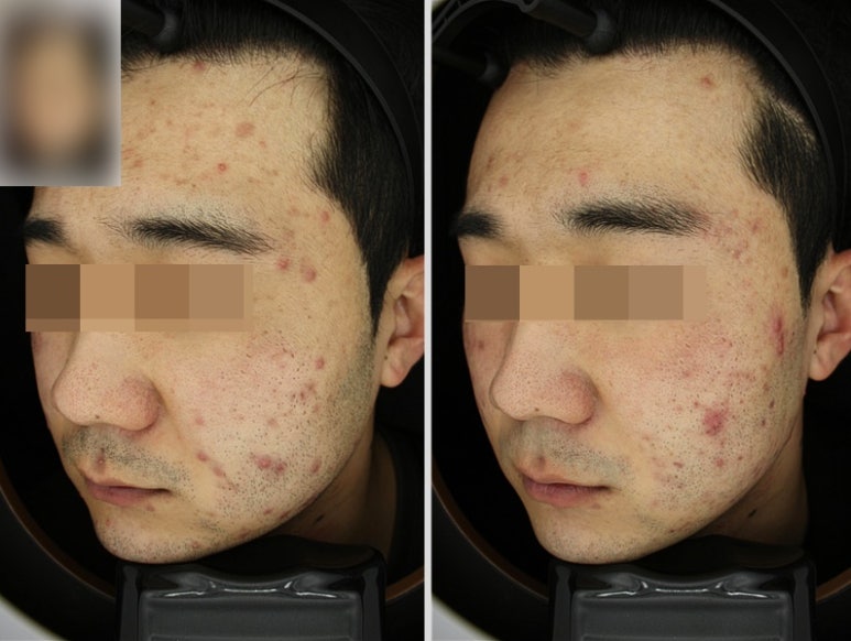 관악구피부과에서 받은 여드름치료 #강력추천! 관련 이미지 3