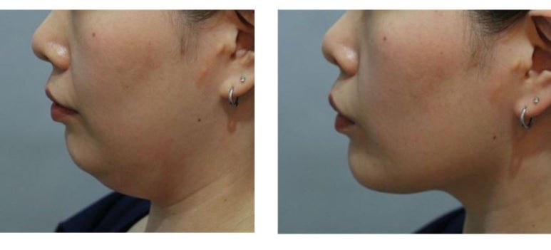 연예인같은 작고 슬림한 얼굴을 만들고싶다면 관악구피부과에서 백옥주사와 인모드 후기 관련 이미지 1