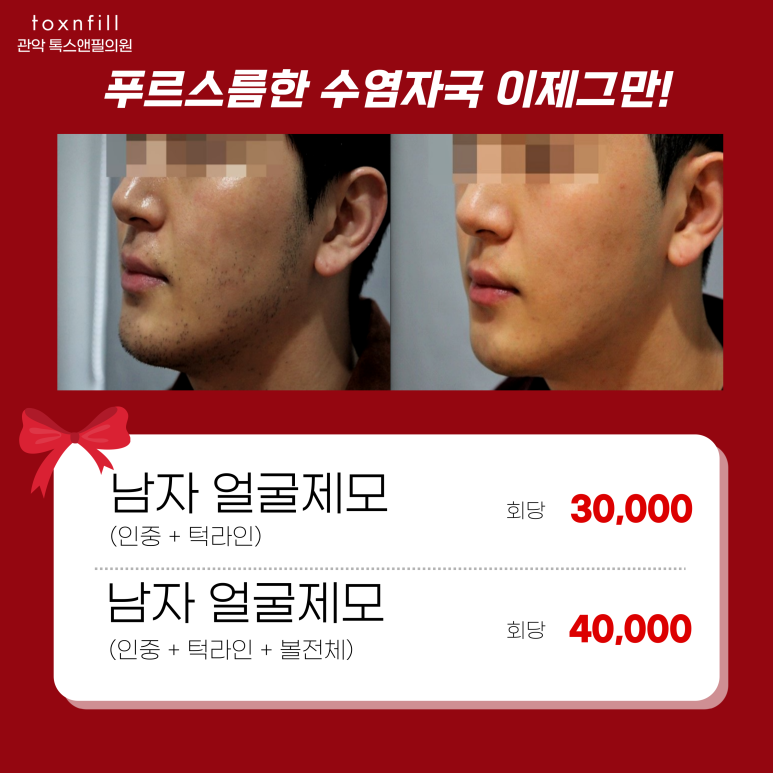 서울대입구역 남자 레이저제모 할인혜택 챙기기 관련 이미지 1