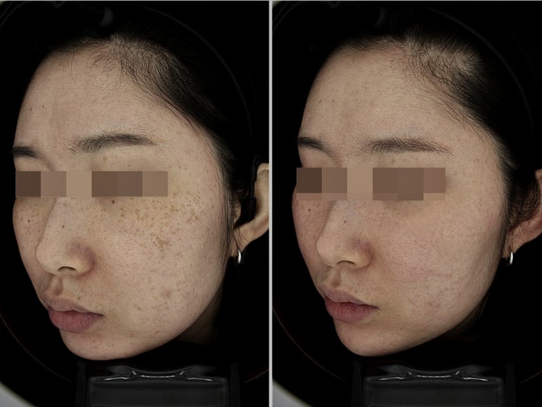 관악구피부과에서 주근깨,기미 치료 전부가능하다고? 관련 이미지 3