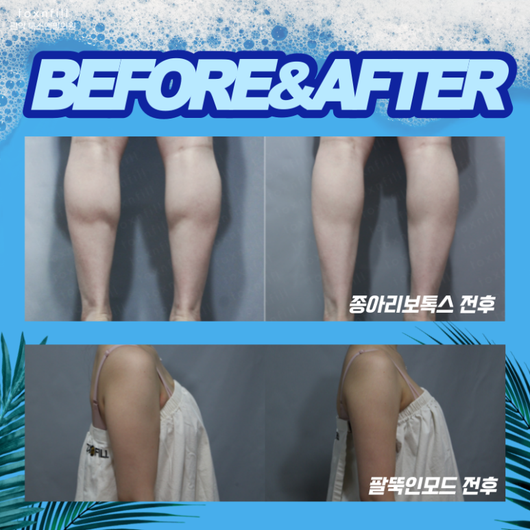 7月 시원하게 빼! 톡스앤필 서울대점 7월 혜택 이벤트! 관련 이미지 4