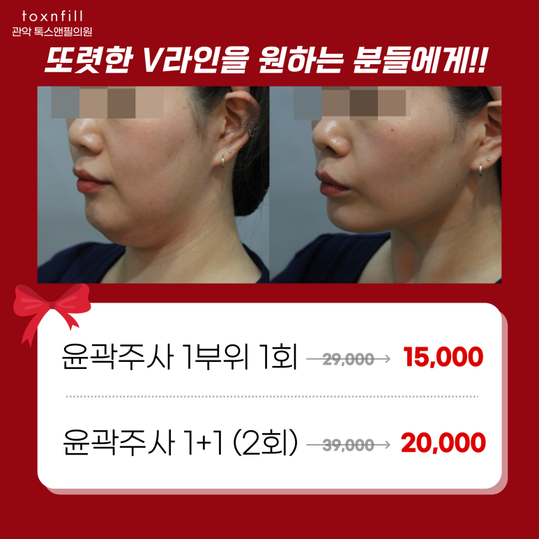 서울대입구역피부과 윤곽주사로 턱선 뷔라인 관련 이미지 5