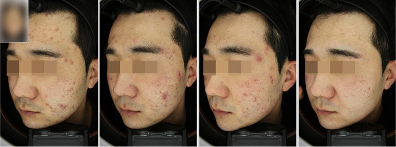 관악구피부과에서 여드름치료로 효과 본 후기! 관련 이미지 3