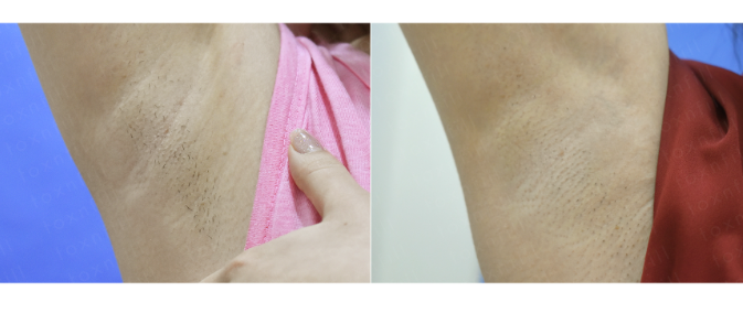 [톡스앤필관악점] 겨드랑이 제모 &인중 제모 레이저로 깔끔하게!! 관련 이미지 1