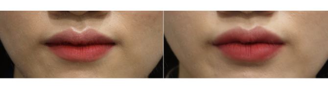 서울대입구역피부과에서 자연스럽게 입술필러맞은 후기 (가격,전후사진,내돈내산) 관련 이미지 3