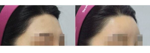 [톡스앤필관악점] 푹꺼진 이마에 자신감을 채워넣다!! 이마필러 후기!! 관련 이미지 1