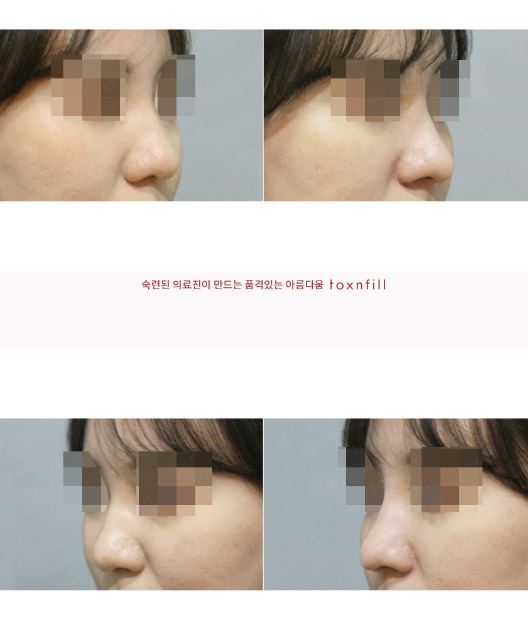 서울대입구역 피부과에서 코필러? 이제는 미쥬코로 관련 이미지 2