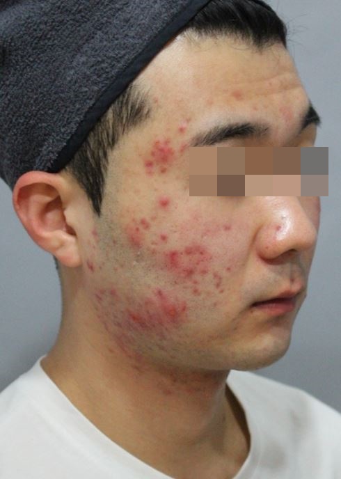 관악구피부과에서 여드름치료로 효과 본 후기! 관련 이미지 1