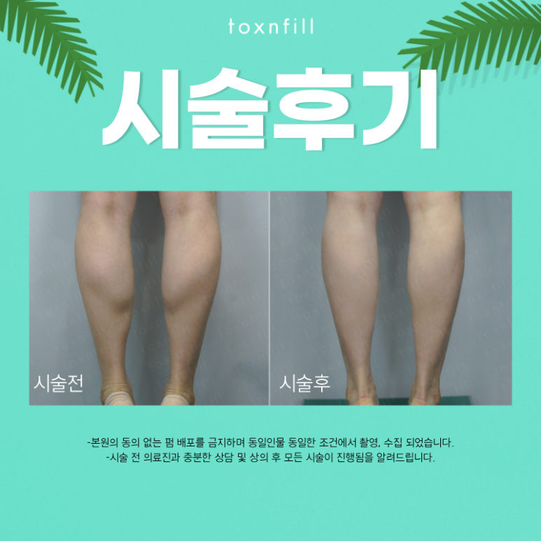 [톡스앤필 서울대점] 종아리알제거 완벽한 슬림다리라인을 위한 선택! 관련 이미지 4