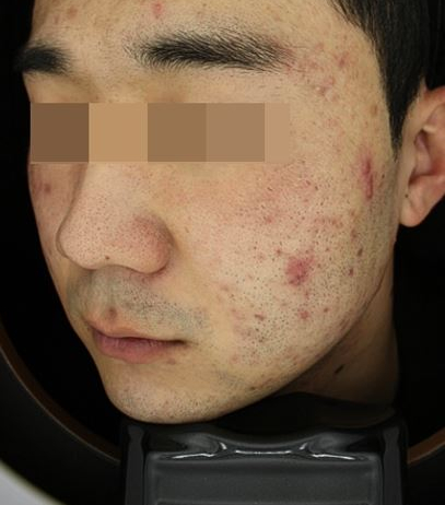 관악구피부과에서 여드름치료 5주간 리얼 후기!(내돈내산) 관련 이미지 3