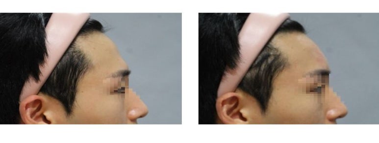 [톡스앤필관악점] 남자이마필러잘하는 관악구 피부과톡스앤필서울대입구점의 남자이마필러후기!! 관련 이미지 1