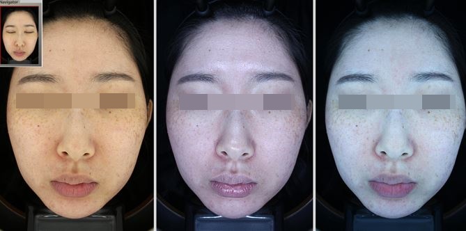 관악구피부과에서 색소집중모드로 주근깨,기미 전부 제거한 후기! 진심효과최고! (내돈내산) 관련 이미지 2