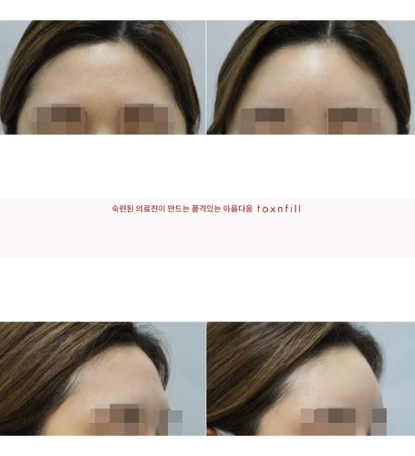 [톡스앤필관악점]관악구피부과에서 맞은 이마필러후기!!이마필러 내돈내산후기 1편!! 관련 이미지 1