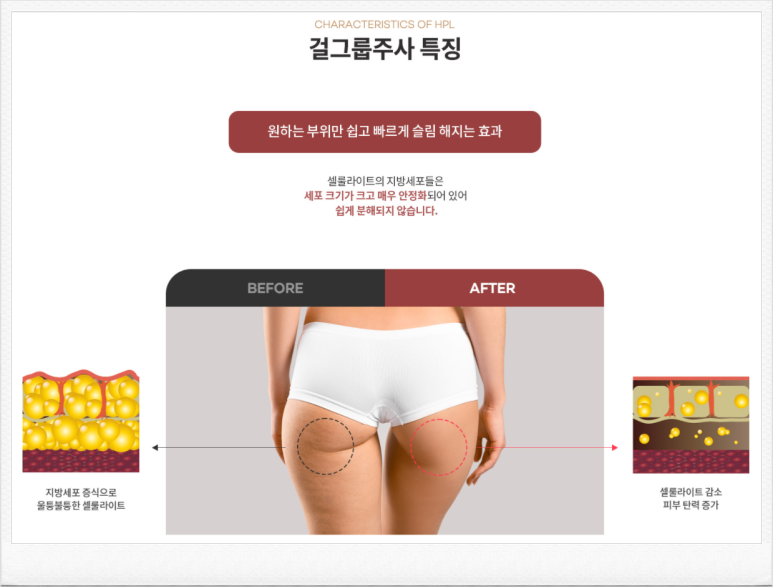 서울대입구 피부과 걸그룹주사(HPL / 지방분해주사)로 급찐급빠! 관련 이미지 6