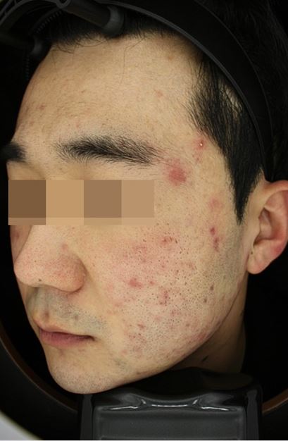 서울대입구역피부과에서 여드름치료가 중요한 이유(5주간의 후기) 관련 이미지 4