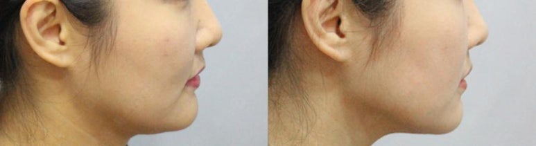 서울대입구역 피부과 윤곽주사로 턱선 갸름하게 관련 이미지 3