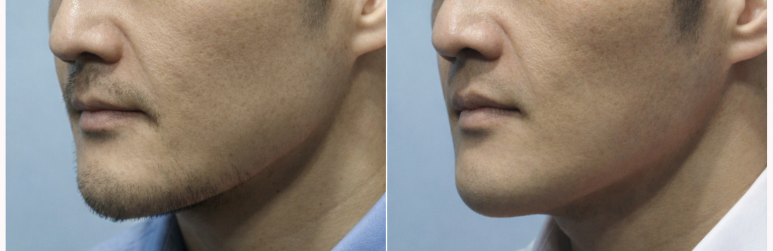 💥Amazing Discount Laser Hair Removal, Now Is the Time! Early Event! image 2