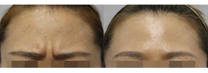 관악구피부과 종아리보톡스,미간보톡스 생생한 후기 관련 이미지 2