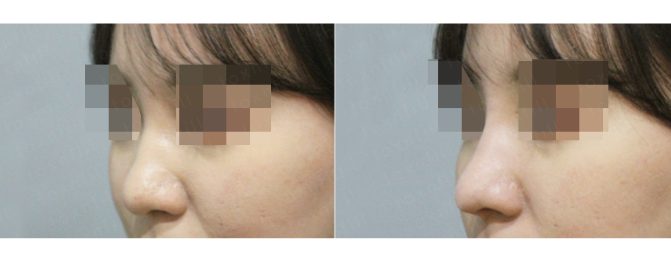 [톡스앤필관악점] 콧대 수술?NO! 이젠 시술로!! 관련 이미지 2