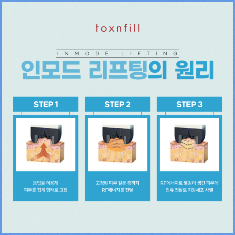 서울대입구역피부과에서 슈모드로 리프팅 한 후기 (인모드와 슈링크유니버스의 힘,가격정보,내돈내산) 관련 이미지 4