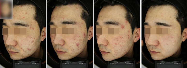 서울대입구역 피부과 여드름치료는 이곳으로 추천! 관련 이미지 3