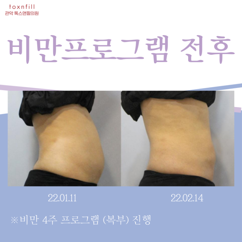 사당역다이어트 요즘 어떻게 다이어트하시나요? 관련 이미지 4