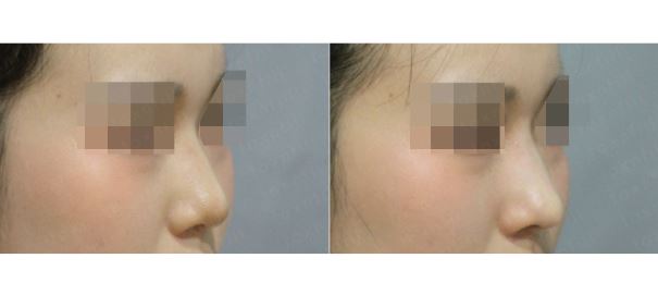 [톡스앤필관악점] 위험한 코수술이 겁난다면? 미쥬코로 오똑한 코 만들기! 미쥬코 후기! 관련 이미지 1