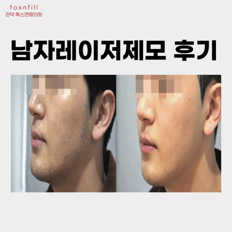 서울대입구역 남자제모 몇회를 해야없어지는지 관련 이미지 4