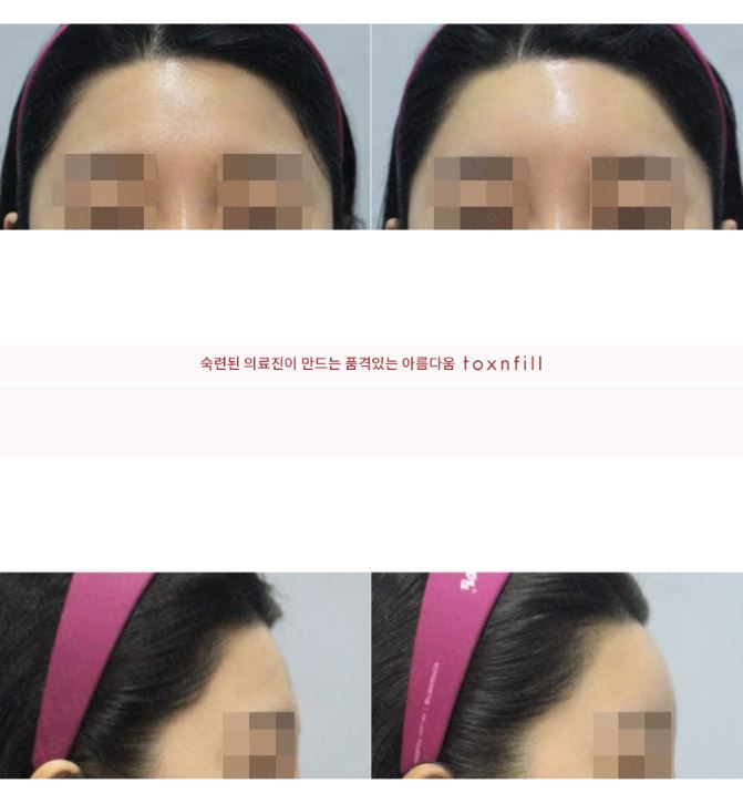 푹꺼진 이마라인 도드라보이는 눈썹뼈! 이제는 관악구피부과에서 이마필러로 채워드림!!후기와정보! 관련 이미지 1