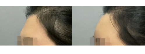 이마의 자신감을 채우다! 관악구피부과에서 알려주는 이마필러 후기와 관련정보!!쮀끼라웃! 관련 이미지 1