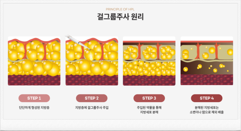 서울대입구 피부과 걸그룹주사(HPL / 지방분해주사)로 급찐급빠! 관련 이미지 5
