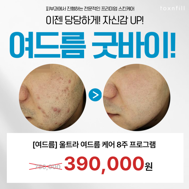 [Toxnfill Seoul National University Branch] Signature Acne Goodbye Package image 1
