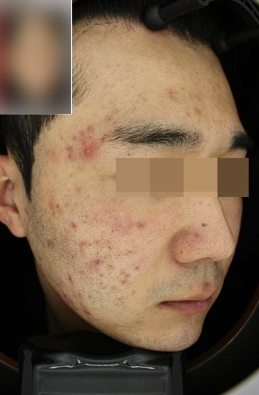 서울대입구역 피부과 여드름치료 후기 5주간의 여정! 관련 이미지 4