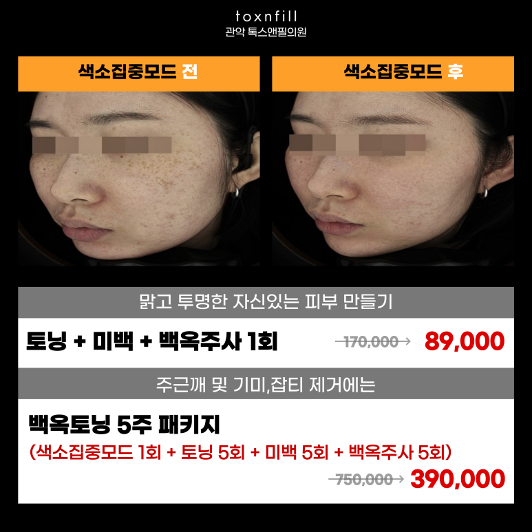 관악구피부과에서 주근깨,기미 치료 전부가능하다고? 관련 이미지 4