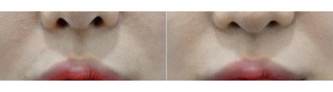 [톡스앤필관악점]인중에 거무틱틱함을 제거하다! 생생한 인중제모 후기!! 관련 이미지 1