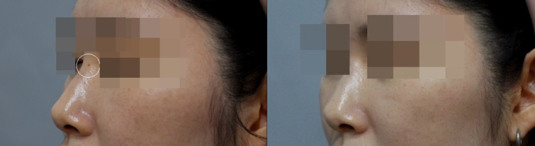 서울대입구역피부과에서 점제거 한 후기 관련 이미지 5