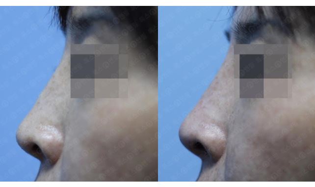 관악구피부과에서 수술이 아닌 코필러로 콧대살린후기 관련 이미지 1