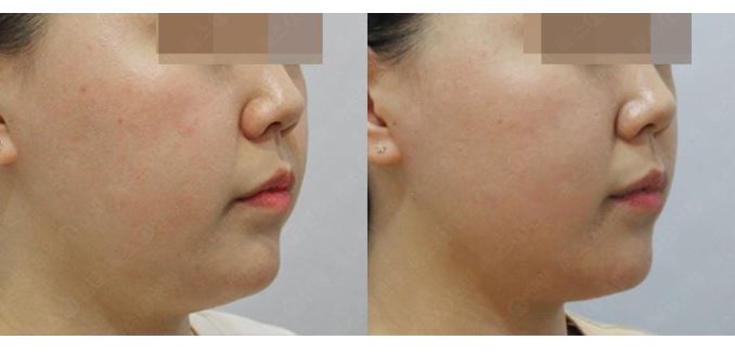 서울대입구역피부과 윤곽주사로 턱선 뷔라인 관련 이미지 3