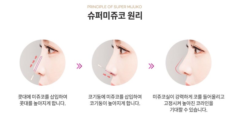 관악구피부과에서 매부리코 코필러가아닌 실로 콧대높히기 관련 이미지 2