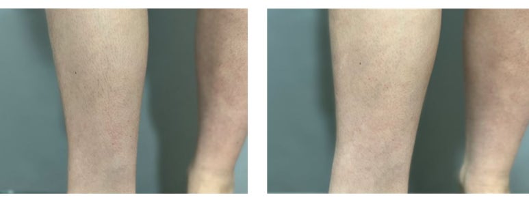 [톡스앤필관악점] 가을겨울철에도 제모는 필수!! 제모후기,다리제모후기!! 관련 이미지 1