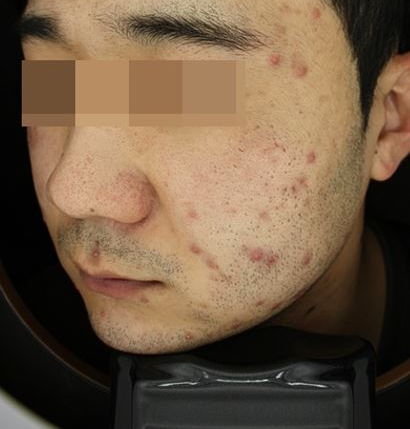 관악구피부과에서 여드름치료 5주간 리얼 후기!(내돈내산) 관련 이미지 2