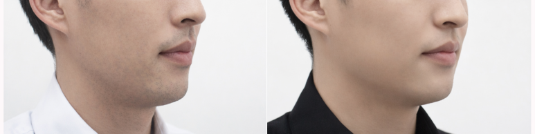 💥Amazing Discount Laser Hair Removal, Now Is the Time! Early Event! image 3