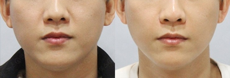 서울대입구역피부과 턱보톡스 후기 관련 이미지 4